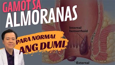 Gamot Sa Almoranas: Anu.